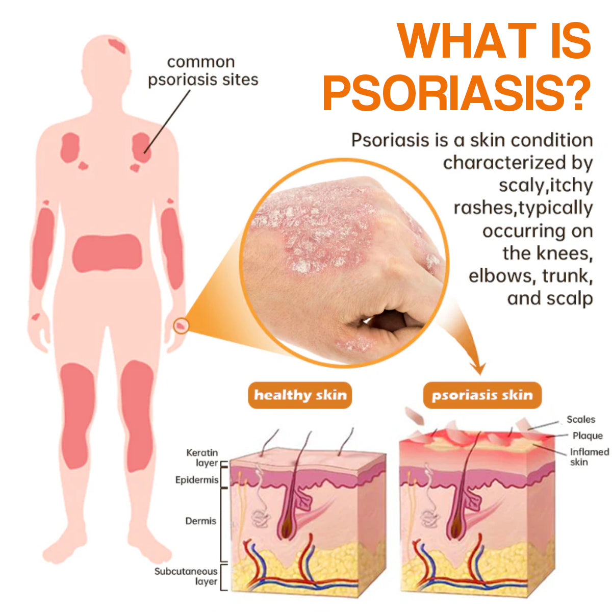 LOVILDSâąPsoriaHeal psoriasis Spray pro