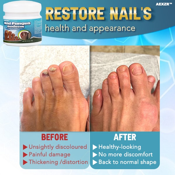 🇪🇸Aexzr™  CREMA  para hongos en las uñas que cura rápidamente👨🏼‍⚕️Aprobado por dermatólogos británicos